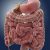 ¿Qué es una obstrucción intestinal? Causas, Síntomas y Tratamiento