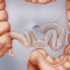 ¿Qué es la estenosis de colon? ¿Cómo se trata?